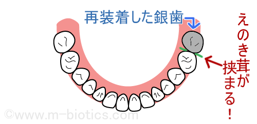 銀歯　クラウン　えのき茸　挟まる　奥歯