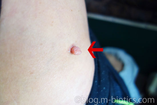 軟性線維腫 手術 いぼ ブログ