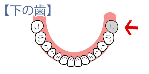 左下7番 噛み合わせ おかしい